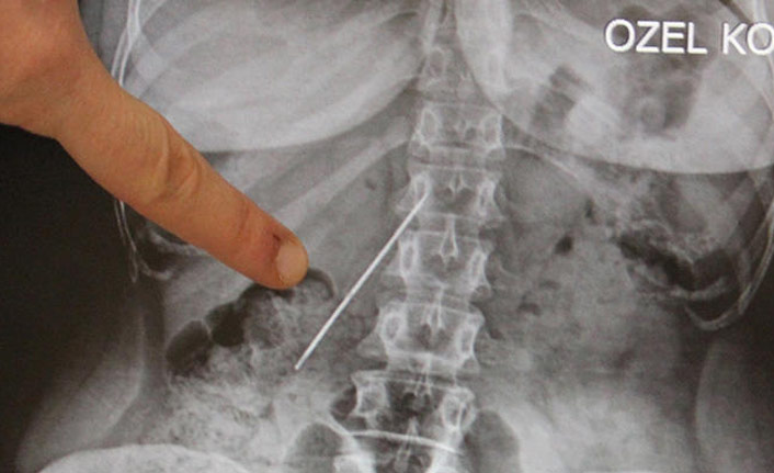 15 santimetre...26 yıldır onunla yaşadı!