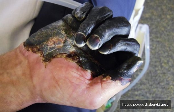 Veba hortladı: 19 ölü