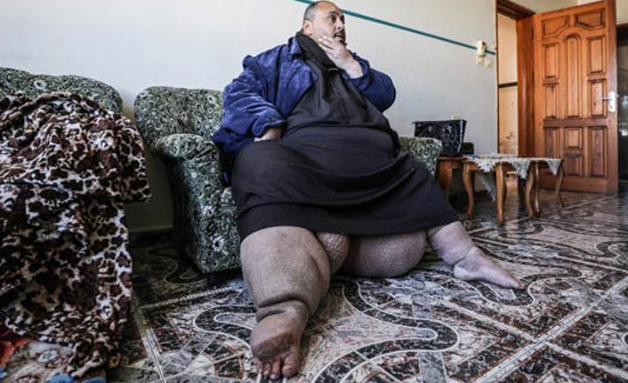 "Fil hastalığı" hayatını kararttı!