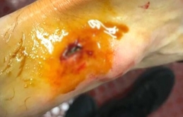 Galatasaraylı futbolcunun ayağı delindi