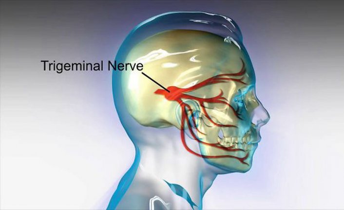 Trigeminal nevralji yani delirten hastalık nedir nasıl tedavi edilir?