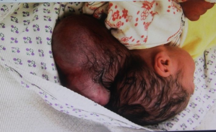 Hatay’da iki kafalı bebek dünyaya geldi