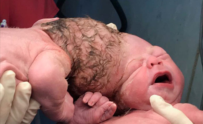 13 günlük Siyam ikizleri yaşam savaşı veriyor