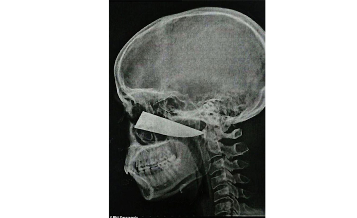 4 gün boyunca kafasında bıçakla gezdi