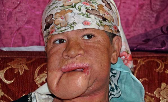 Sivilce sandı kanser olduğunu öğrendi