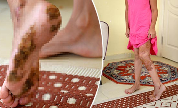 Cilt kanseri hayatını kararttı