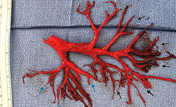Şiddetli öksürükle akciğerini tükürdü