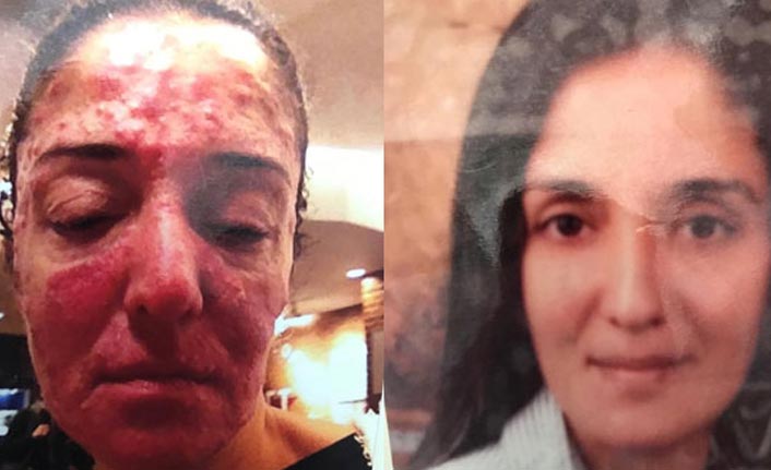 Çalışanının suratına kezzap...