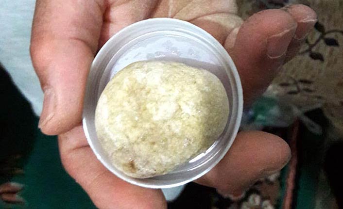 Doktorlar bile şaşkına döndü! Tam 300 gram