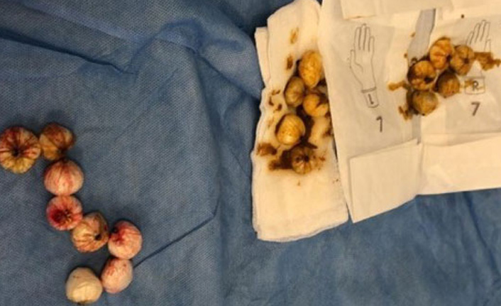 Mide ve bağırsaklarından 21 gram...