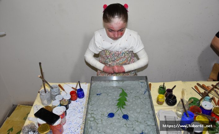 Kelebek hastası Ayşenur sanatla hayata tutunuyor