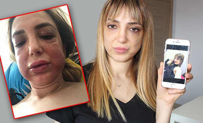 Estetik sonrası tanınmaz hale geldi