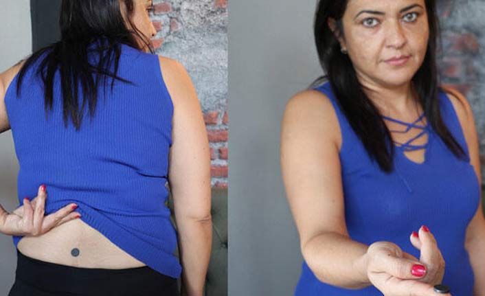 6 yıl boyunca belindeydi! Mıknatıs ile...