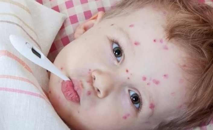 Çocuklarda kızamık hastalığına dikkat!