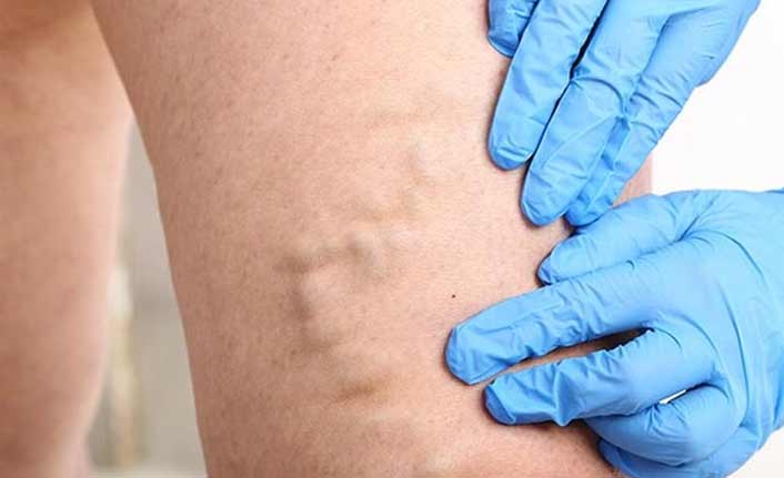 Yaz sıcakları, varis şikayetlerini arttırıyor