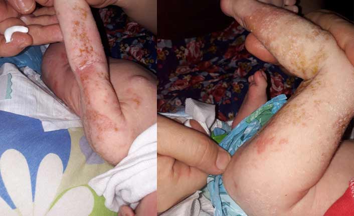 8 aylık Rukiye vücudunu kapayan yaralarla mücadele ediyor