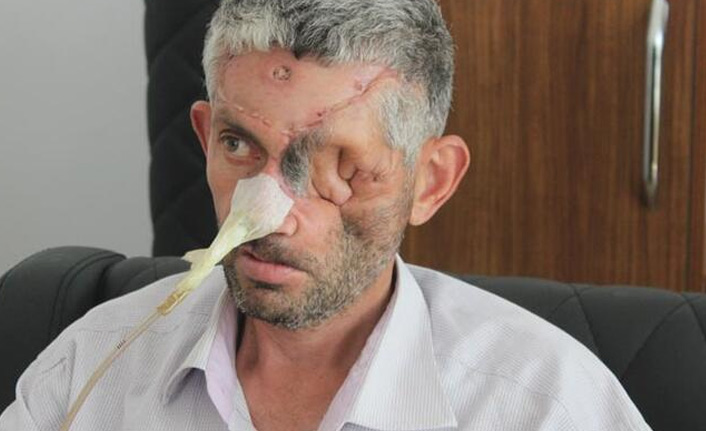 Dişini çektirdi, yüzünü kaybetti!