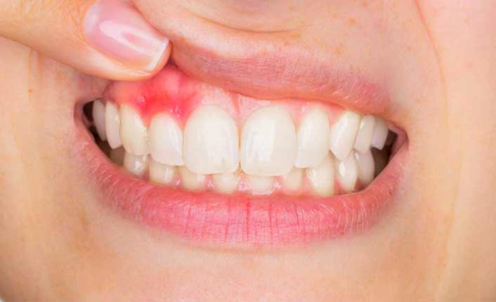 Diş Hekimi Uzunpınar’dan diş eti hastalıkları için önemli uyarılar