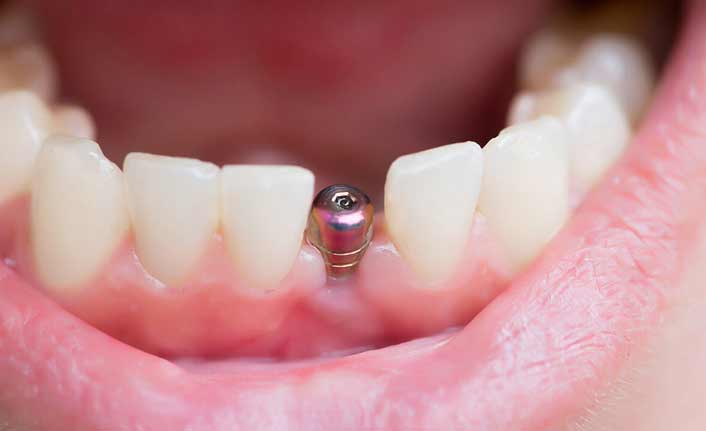 İmplant Sonrası Nelere Dikkat Edilmeli? Uzmandan Önemli Uyarılar