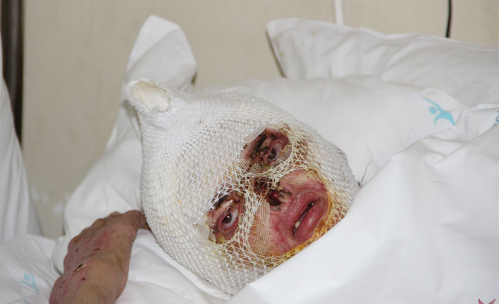 Tüp patlaması sonucu yanan kadın 2 aydır iyileşeceği günü bekliyor
