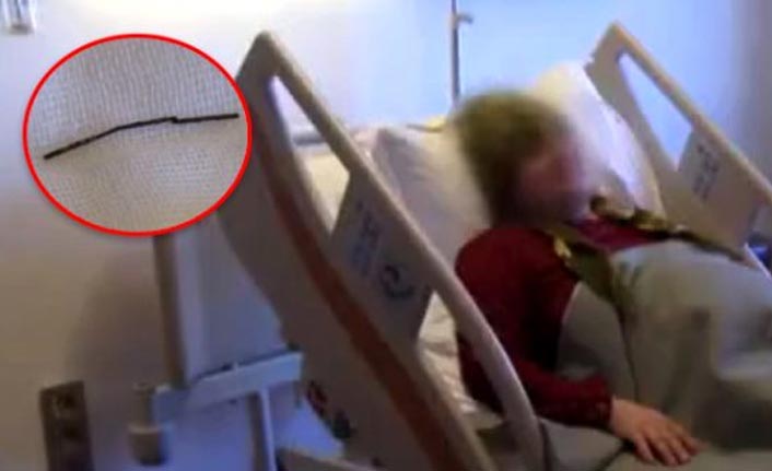 Yuttuğu dikiş iğnesiyle 16 yıl yaşadı