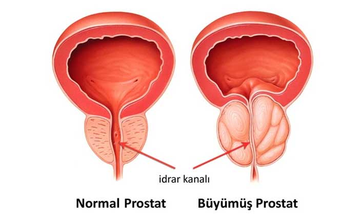 Prostat büyümesi tedavisinde bitkisel ilaçların yeri artıyor!