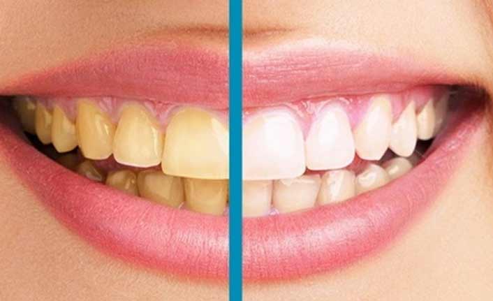 Diş beyazlatmada uzman uyarısı: Jellere karşı dikkat çağrısı