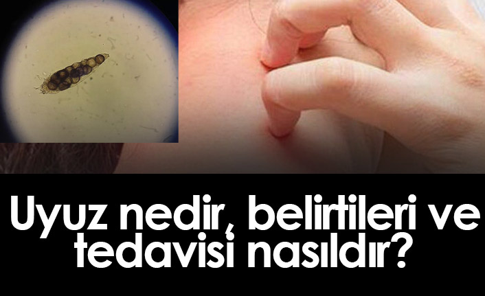 Uyuz Nedir, Nasıl Bulaşır, belirtileri nelerdir? Uyuz tedavisi nasıl yapılır?