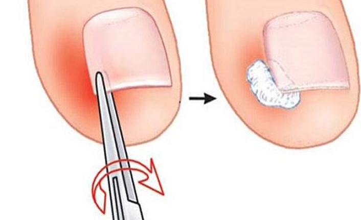 Tırnak Batması Tedavisinde En Sık Yapılan Hatalara Uzmandan Uyarı