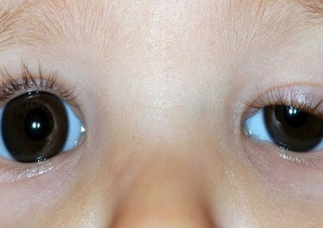 Çocuklarda göz kapağı düşüklüğü önemsenmeli