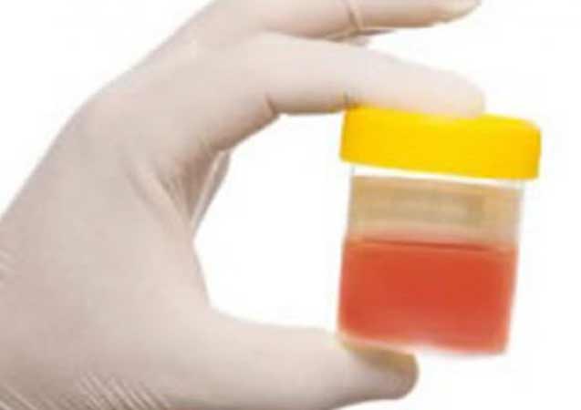 İdrarda Kan Görülmesi Ciddi Hastalıkların İlk Belirtisi Olabilir