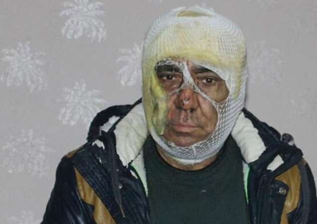 Evinde çıkan yangını söndürmek isterken ölümden döndü!