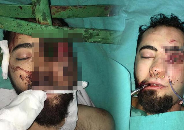 Yüzüne demir saplanan genci, itfaiye ve plastik cerrahlar kurtardı