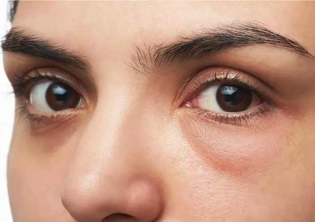 Göz altı torbaları neden olur? Tedavisi nedir? İşte cevabı...