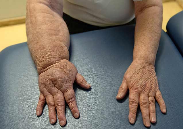 Meme kanseri tedavisi gören hastalarda lenfödem tehlikesi