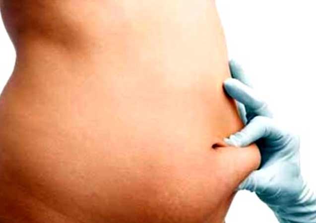 Hamilelik sonrası estetik problemlere dikkat!