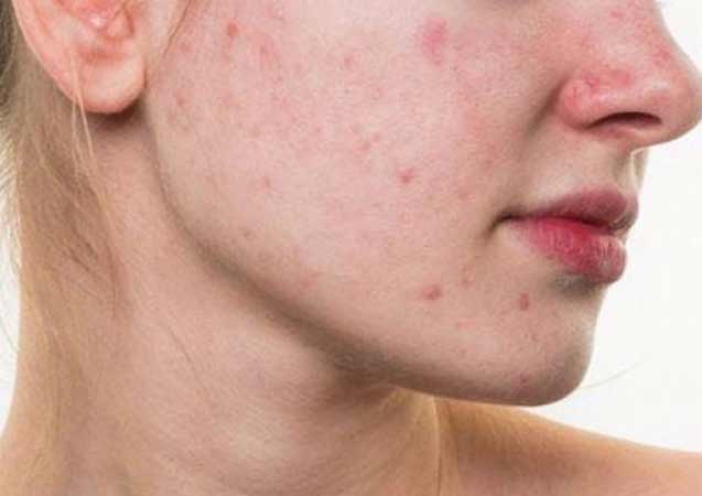 Dr. Ayfer Aydın’dan akne ve sivilce tedavisinde etkili yöntem uyarısı