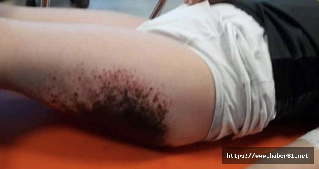 Bahçede oynayan öğrencilerin vücutlarında yanıklar oluştu