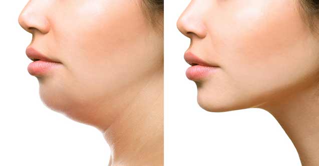 Kadınlarda gıdı sarkmasına dikkat!