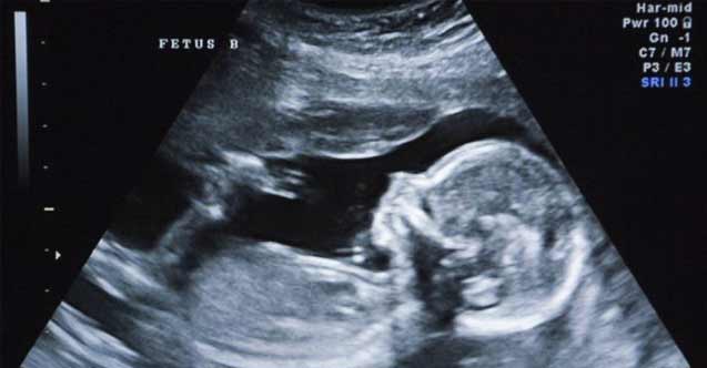 Down sendromu, anne karnında belirlenebilir