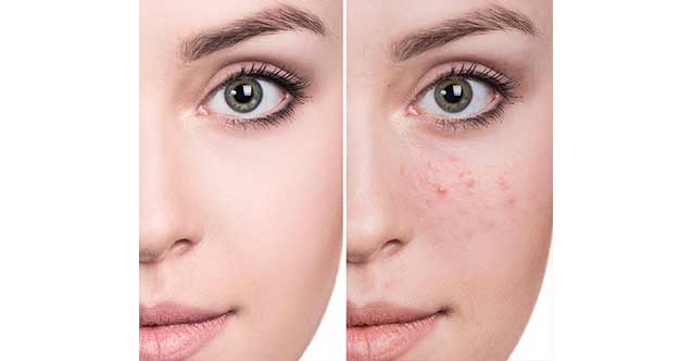 Cilt lekelerinden kurtulmanın yolları nelerdir? İşte cevabı...