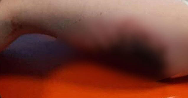 Karla oynarken vücutlarında yanık oluşan 2 çocuğa doku nakli yapılacak