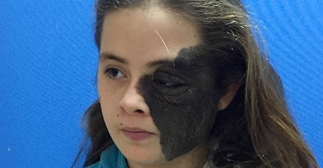 Yüzünün yarısını kaplamıştı! Sonunda kurtulacak