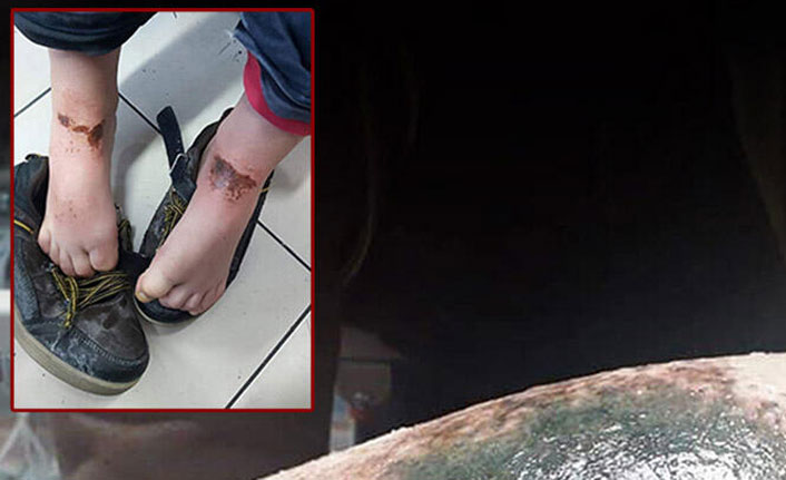 Afyonkarahisar'da öğrencilerin vücutlarındaki yanıkların sebebi belli oldu