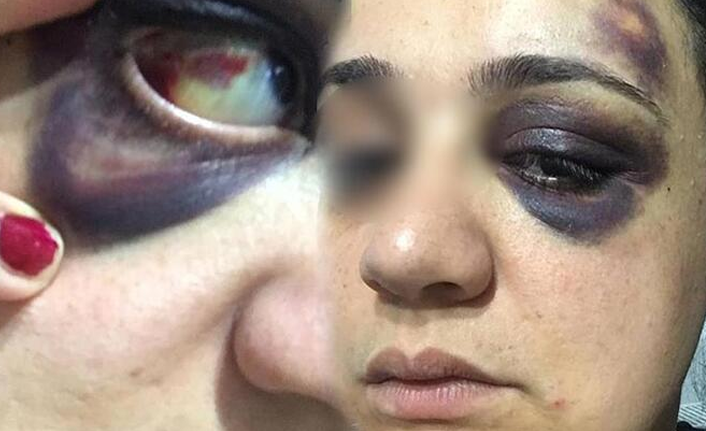 Eşi bu hale getirmişti! Verilen cezalar ertelendi