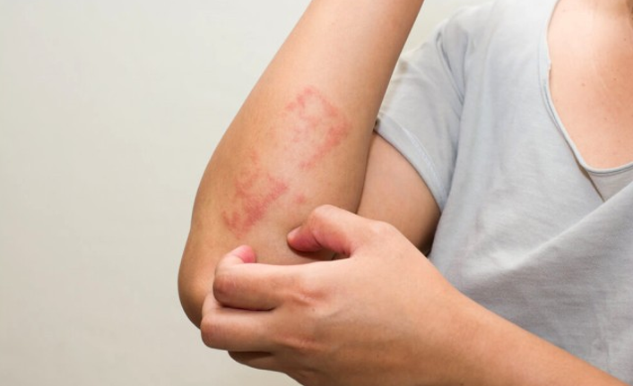 Gıda katkı maddeleri çocuklarda ciddi alerjik reaksiyonları tetikleyebiliyor