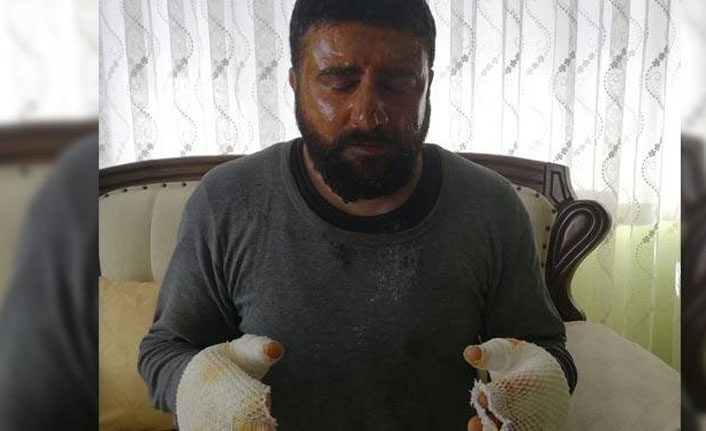 Elektrik çarpması sonucu ağır yaralanmıştı! Sevindiren haber geldi