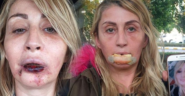 Dolgu yapılan dudağını kaybetmişti! Artık yemek yiyebiliyor