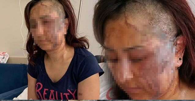 Boşanmak isteyen eşine kezzapla saldırdı!
