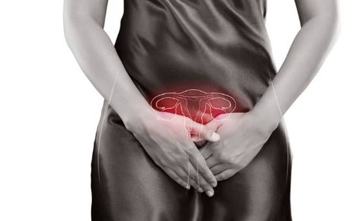 'Çikolata kistleri infertiliteye yol açabilir"